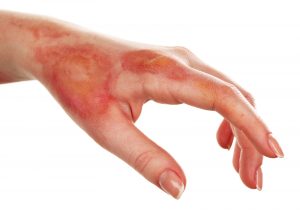 Image of hand with scalding burn